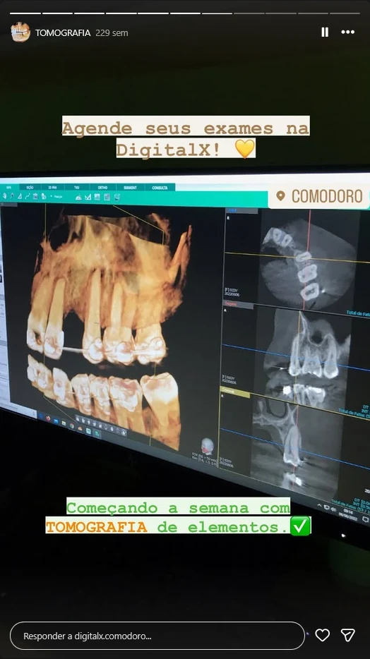Registro de tomografia de elementos dentários da DigitalX